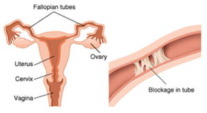 fallopian tube blockage